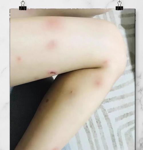 蚂蚁咬月季根的处理方法是什么？